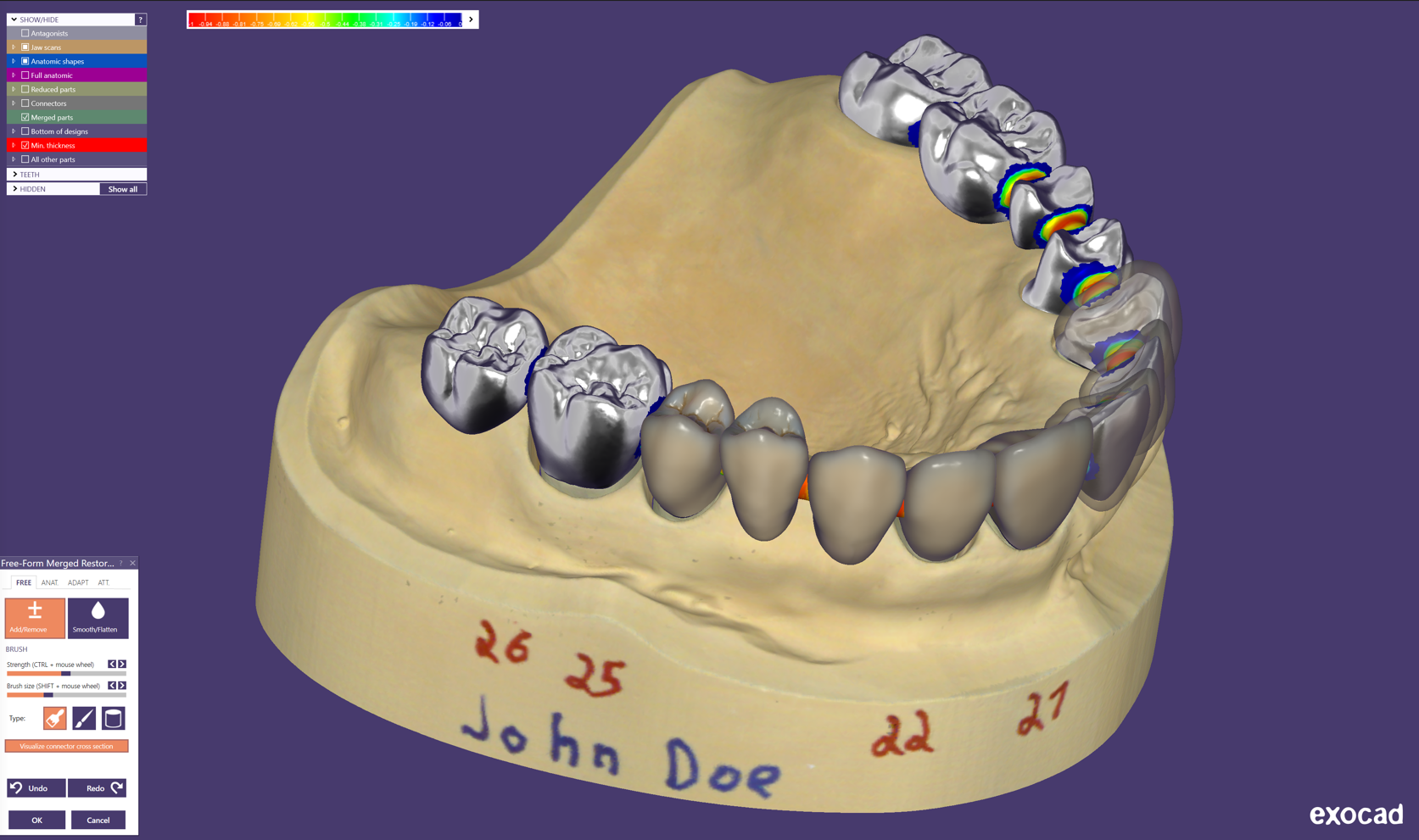 exocad　歯科用CADソフトウェア　exocad DentalCAD