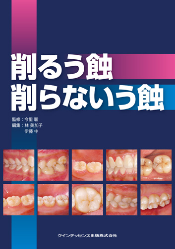 削るう蝕 削らないう蝕
