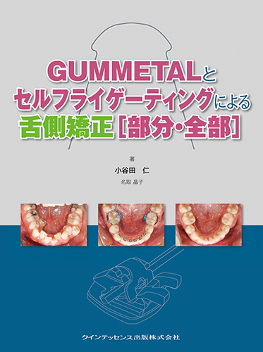 GUMMETALとセルフライゲーティングによる舌側矯正［部分・全部］