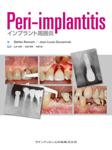 Peri-implantitis
