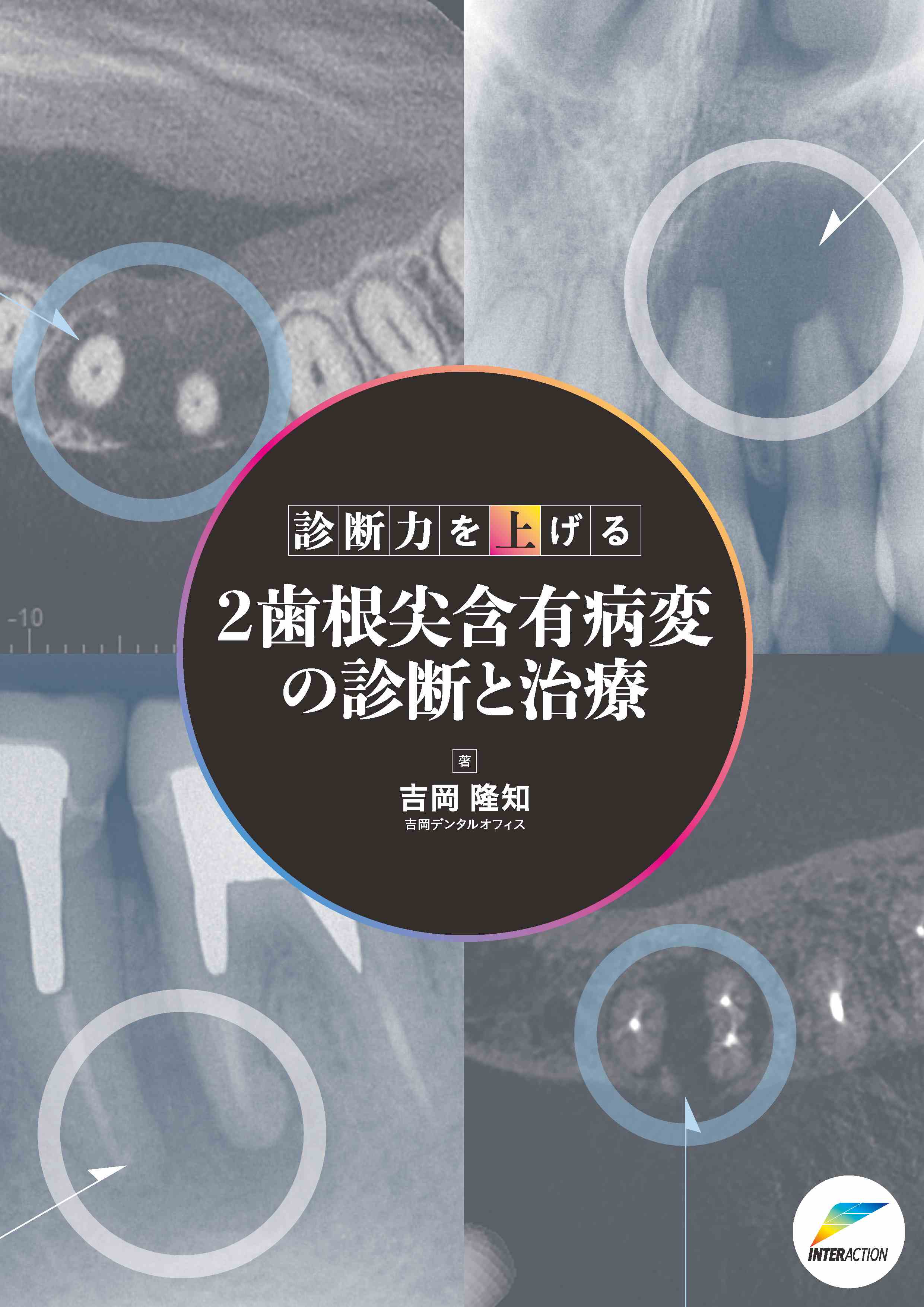 診断力を上げる 2歯根尖含有病変の診断と治療